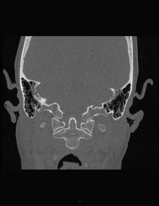 Bilateral frontal mucoceles (Radiopaedia 82352-96454 Coronal 343).jpg