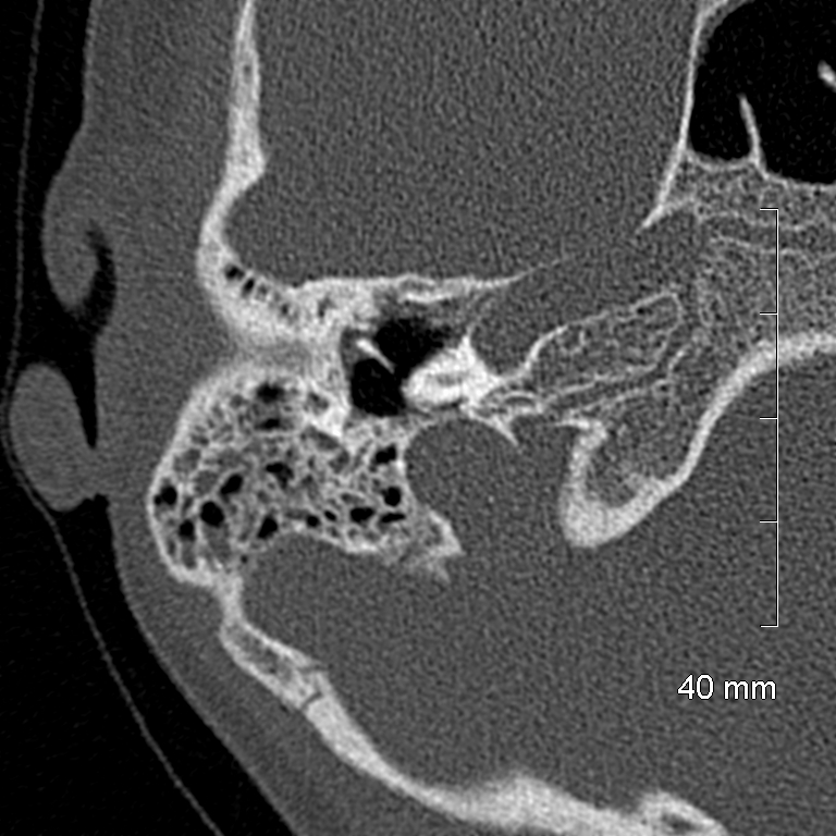 Bilateral grommets (Radiopaedia 47710-52404 Axial bone window 31).jpg