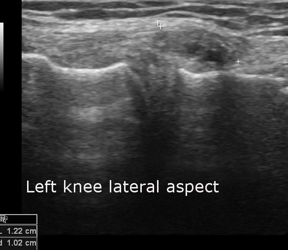 File:Bilateral lateral meniscal cysts (Radiopaedia 12200-12525 E 1).jpg