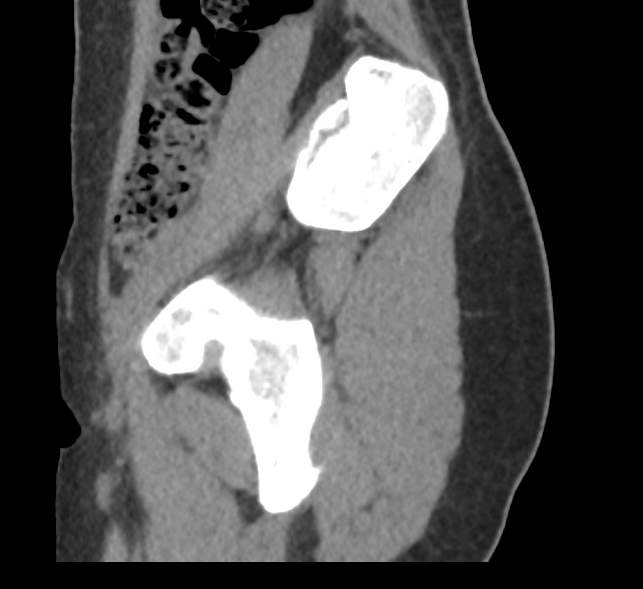 Bilateral mature cystic ovarian teratoma (Radiopaedia 88821-105592 D 2).jpg