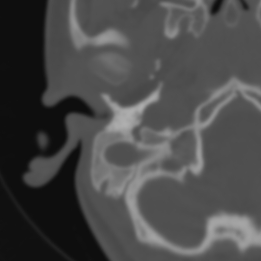 Bilateral otosclerosis (Radiopaedia 57237-64157 B 21).jpg