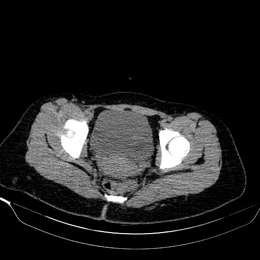 File:Bilateral ovarian dermoid (Radiopaedia 45714-49907 Axial non-contrast 35).JPEG