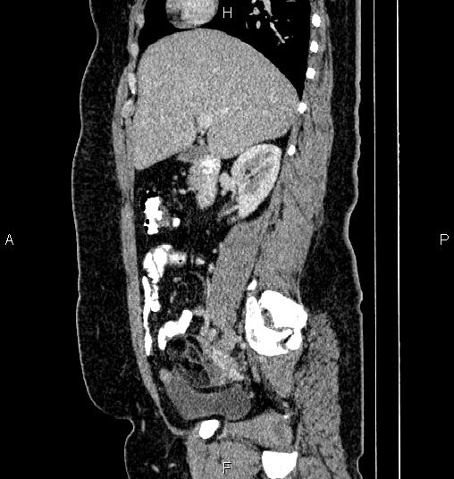 File:Bilateral ovarian dermoid cysts (Radiopaedia 85785-101603 D 30).jpg