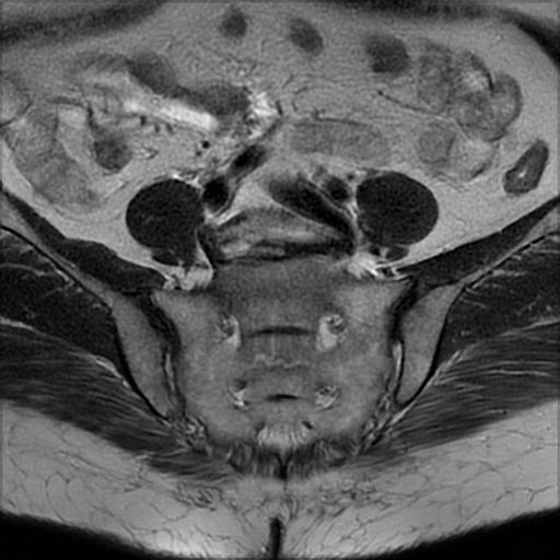 File:Bilateral ovarian dermoid cysts (Radiopaedia 90152-107338 Axial T2 3).jpg