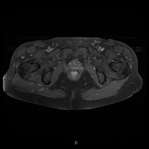 File:Bilateral ovarian fibroma (Radiopaedia 44568-48293 Axial T1 C+ fat sat 25).jpg