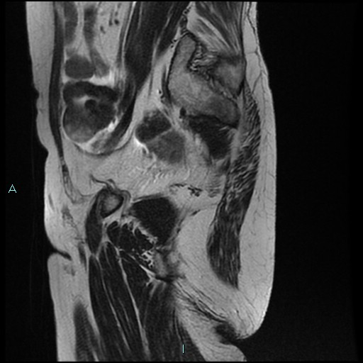 File:Bilateral ovarian fibroma (Radiopaedia 44568-48293 Sagittal T2 27).jpg