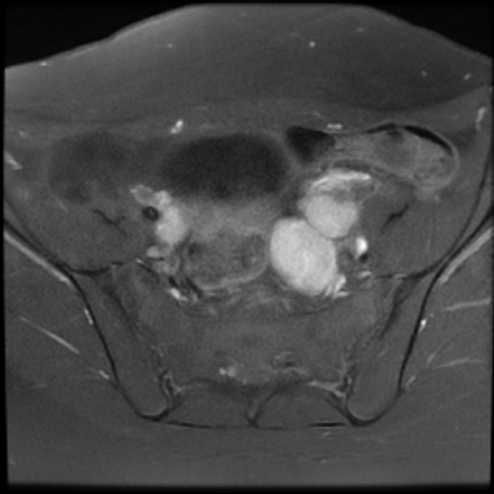 File:Bilateral ovarian fibrothecomas - adolescent (Radiopaedia 86604-102707 Axial T1 C+ fat sat 10).jpg