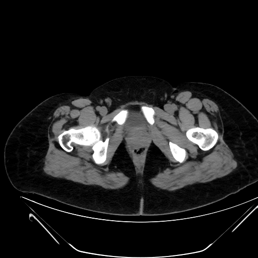 File:Bilateral ovarian mature cystic teratomas (Radiopaedia 79373-92457 Axial non-contrast 93).jpg