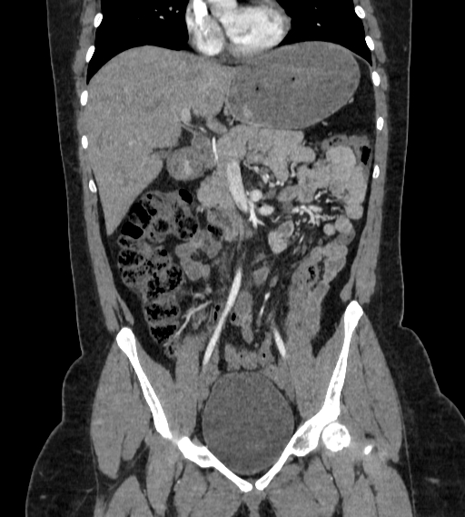 File:Bilateral ovarian mature cystic teratomas (Radiopaedia 79373-92457 B 24).jpg