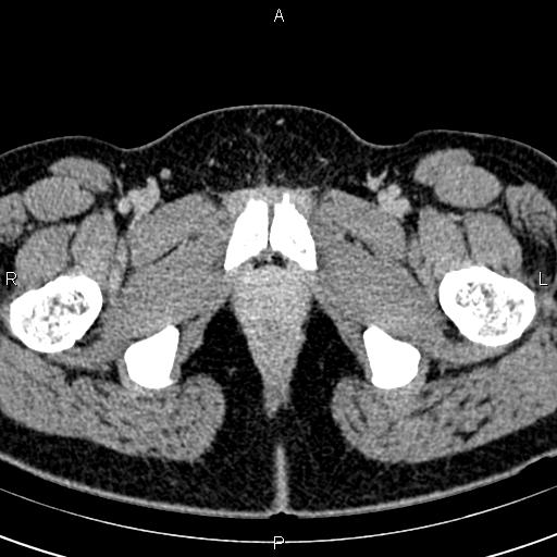 Bilateral ovarian teratoma (Radiopaedia 83131-97503 B 84).jpg