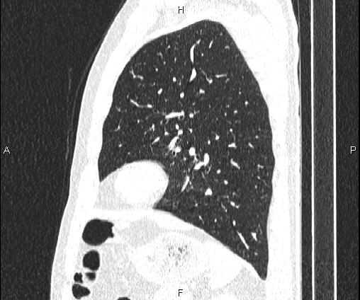 Bilateral pulmonary AVM (Radiopaedia 83134-97505 Sagittal lung window 82).jpg