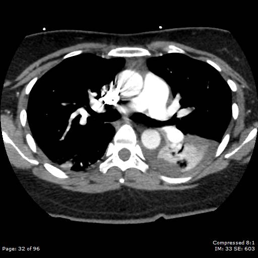 Bilateral pulmonary emboli with Hampton hump sign (Radiopaedia 54070-60246 Axial C+ CTPA 29).jpg