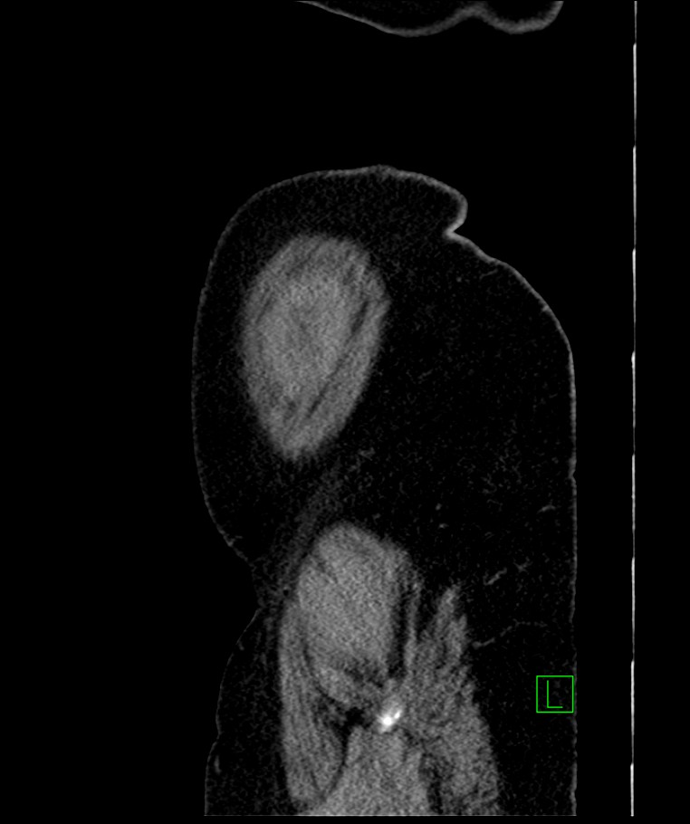 Bilateral sporadic synchronous clear cell renal cell carcinoma (Radiopaedia 85035-100575 E 10).jpg