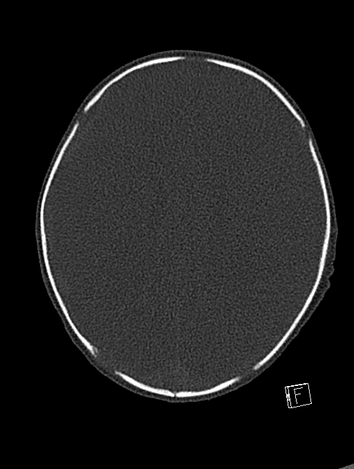 Bilateral subdural hemorrhage and parietal skull fracture (Radiopaedia 26058-26192 Axial bone window 47).png