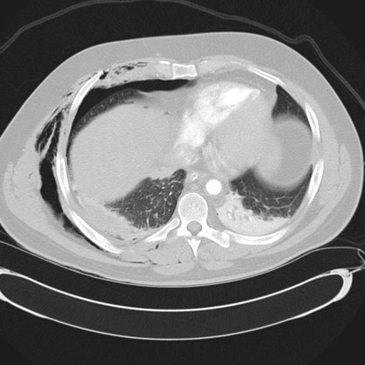 Bilateral traumatic renovascular injury (Radiopaedia 32051-32995 Axial lung window 36).jpg