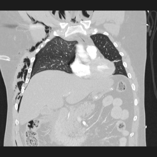Bilateral traumatic renovascular injury (Radiopaedia 32051-32995 Coronal lung window 29).jpg