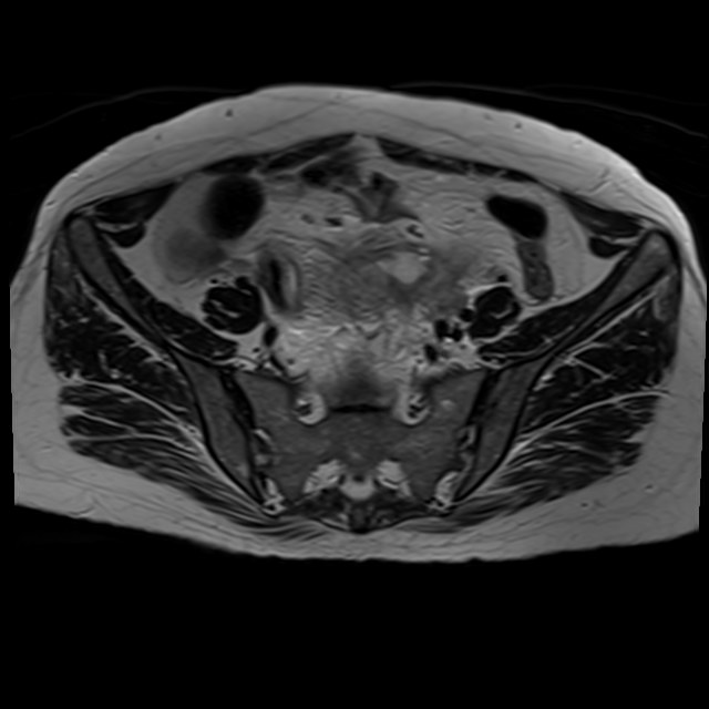 Bilateral tubo-ovarian abscesses (Radiopaedia 58635-65829 Axial T2 11).jpg