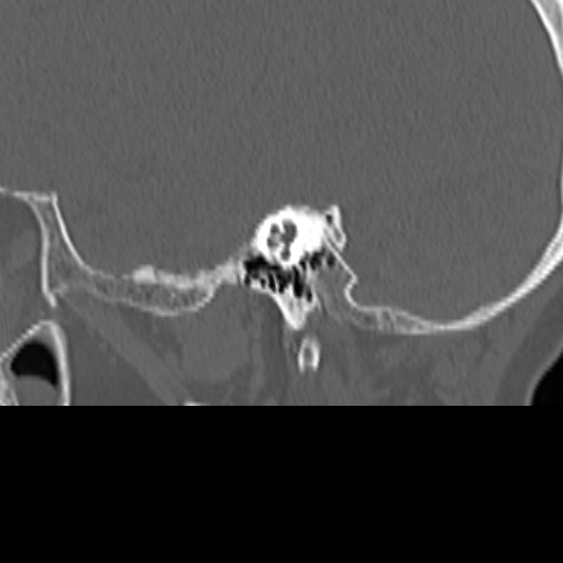 Bilateral tympanoplasty (Radiopaedia 16947-16664 Sagittal bone window 40).jpg