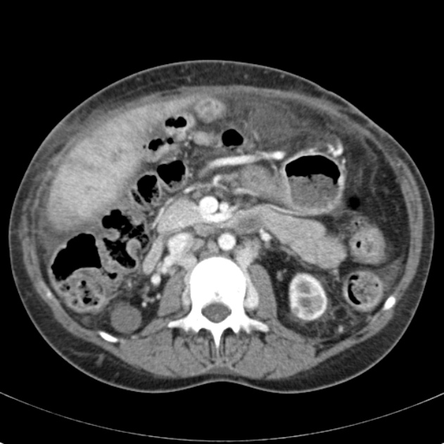 Biliary necrosis - liver transplant (Radiopaedia 21876-21846 B 33).jpg