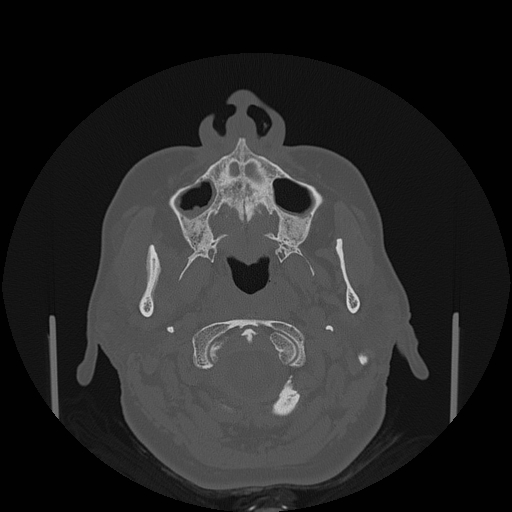 File:Bisphosphonate-related osteonecrosis of the jaw (Radiopaedia 71324-81642 Axial bone window 120).jpg
