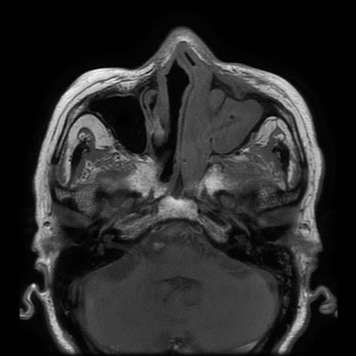 Bisphosphonate-related osteonecrosis of the maxilla (Radiopaedia 51367-57101 Axial T1 32).jpg