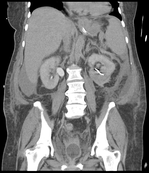 File:Bladder rupture post renal biopsy (Radiopaedia 30863-31572 Coronal non-contrast 36).jpg