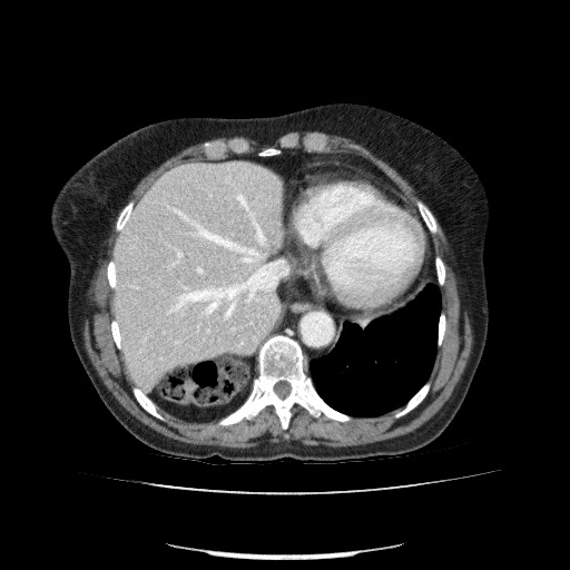 File:Bladder tumor detected on trauma CT (Radiopaedia 51809-57609 B 21).jpg