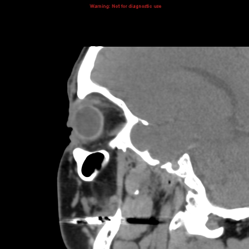 File:Blowout fracture with inferior rectus entrapment (Radiopaedia 12418-12673 C 6).jpg