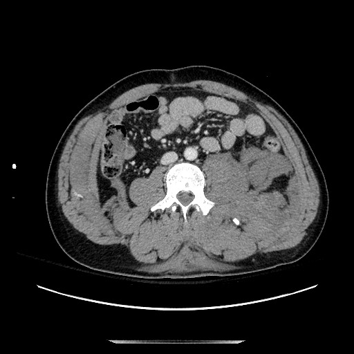 Blunt abdominal trauma with solid organ and musculoskelatal injury with active extravasation (Radiopaedia 68364-77895 A 83).jpg