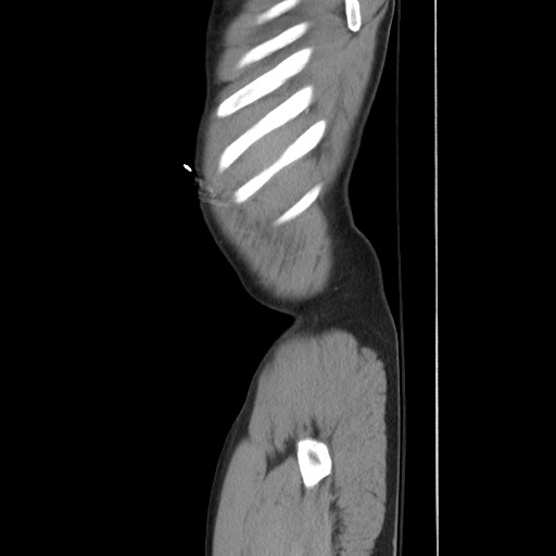 File:Blunt abdominal trauma with solid organ and musculoskelatal injury with active extravasation (Radiopaedia 68364-77895 C 21).jpg