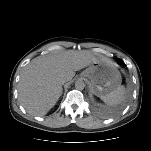 Boerhaave syndrome (Radiopaedia 59796-67310 Axial liver window 57).jpg