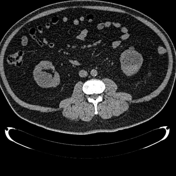 Bosniak renal cyst - type IV (Radiopaedia 24244-24518 Axial non-contrast 166).jpg