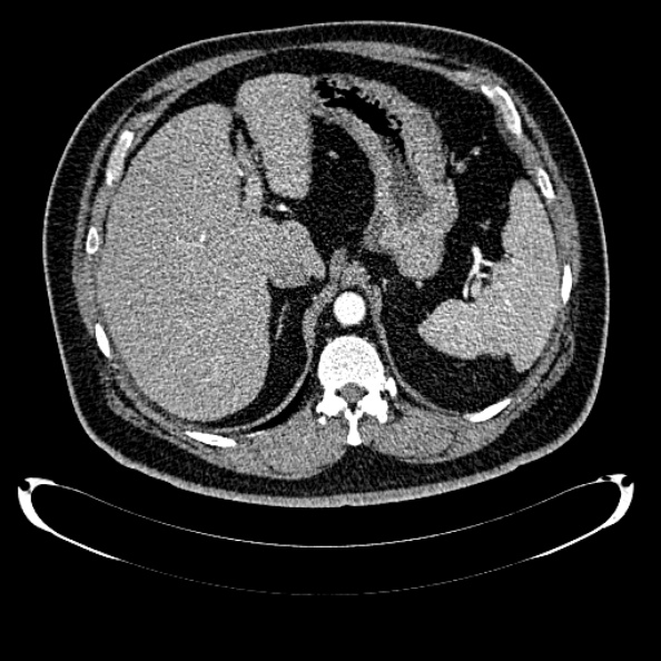 Bosniak renal cyst - type IV (Radiopaedia 24244-24518 B 68).jpg