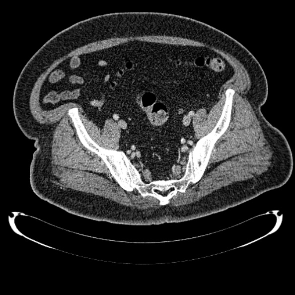 Bosniak renal cyst - type IV (Radiopaedia 24244-24518 C 326).jpg