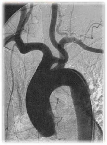 File:Bovine aortic arch (Radiopaedia 22280-22317 Frontal Aorta 1).jpg