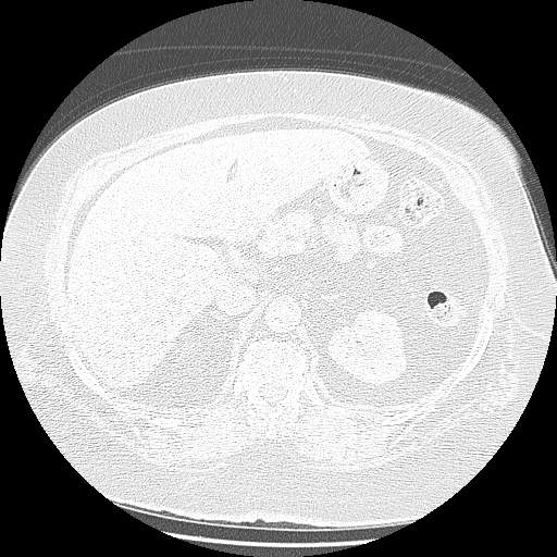 Bovine aortic arch - right internal mammary vein drains into the superior vena cava (Radiopaedia 63296-71875 Axial lung window 193).jpg