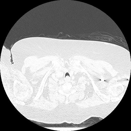 Bovine aortic arch - right internal mammary vein drains into the superior vena cava (Radiopaedia 63296-71875 Axial lung window 3).jpg