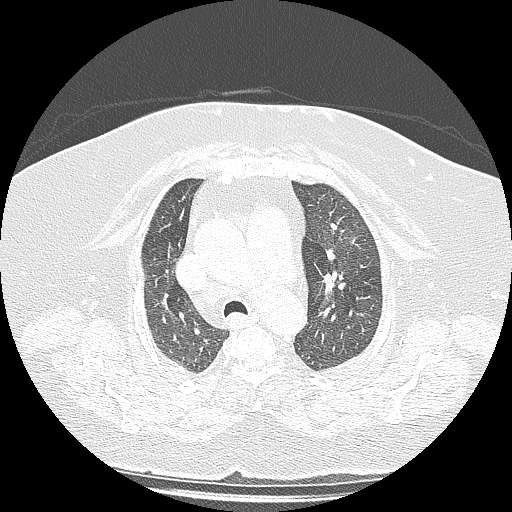 Bovine aortic arch - right internal mammary vein drains into the superior vena cava (Radiopaedia 63296-71875 Axial lung window 45).jpg