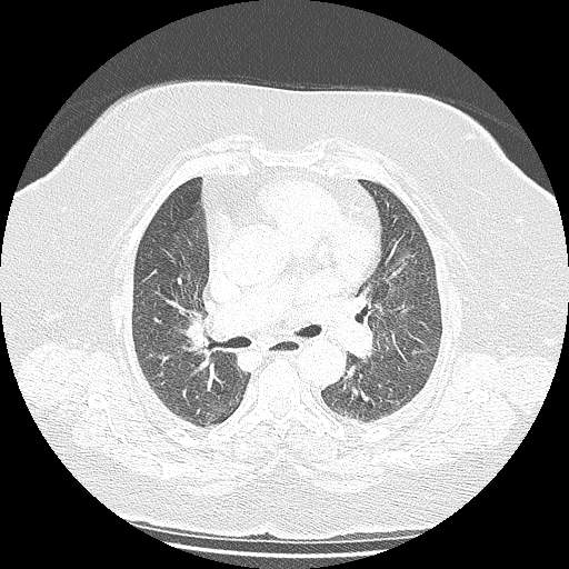 Bovine aortic arch - right internal mammary vein drains into the superior vena cava (Radiopaedia 63296-71875 Axial lung window 68).jpg