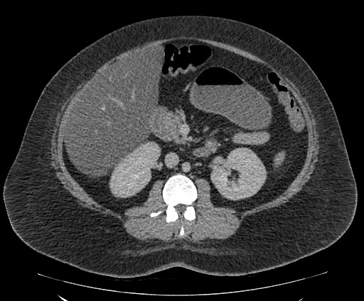Bowel and splenic infarcts in acute lymphocytic leukemia (Radiopaedia 61055-68913 A 60).jpg