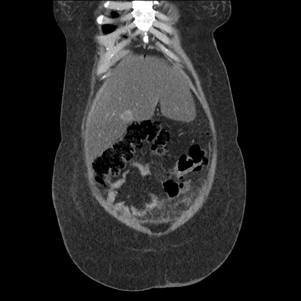 Bowel and splenic infarcts in acute lymphocytic leukemia (Radiopaedia 61055-68915 B 14).jpg