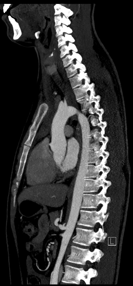 Brachiocephalic trunk pseudoaneurysm (Radiopaedia 70978-81191 C 53).jpg
