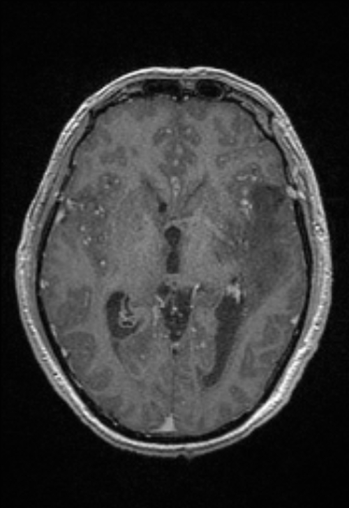 Brain abscess with ventriculitis (Radiopaedia 85703-101495 Axial T1 C+ 88).jpg