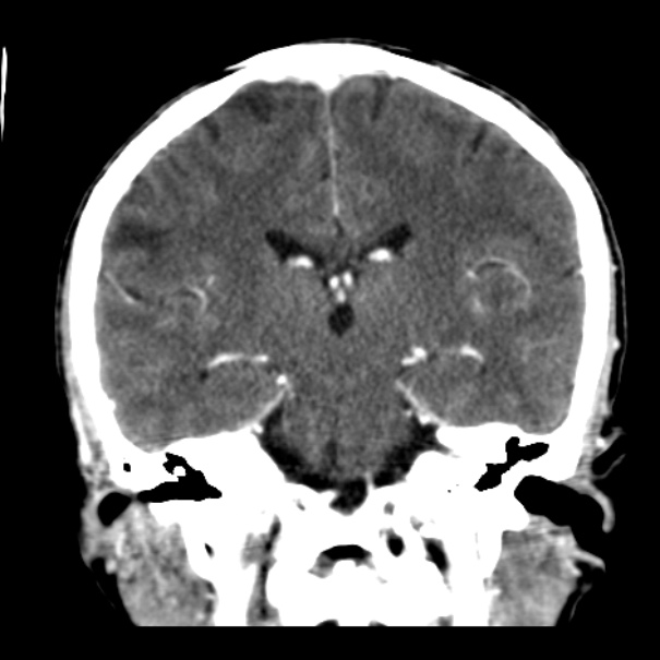 Brain metastases from lung cancer (Radiopaedia 24480-24781 Coronal C+ delayed 36).jpg