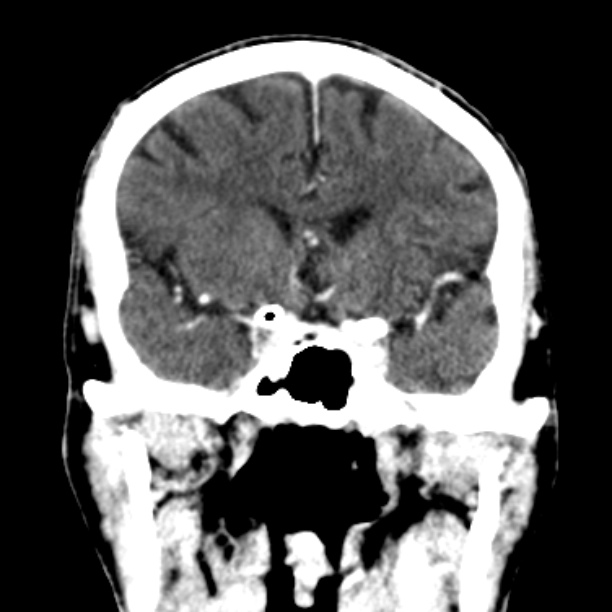 Brain metastases from lung cancer (Radiopaedia 27849-28092 Coronal C+ delayed 25).jpg