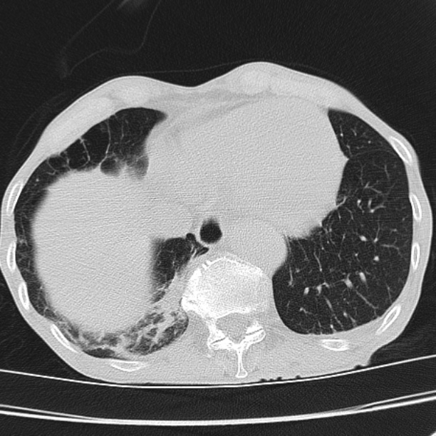 Brain metastases from lung cancer (Radiopaedia 27849-28093 Axial lung window 53).jpg