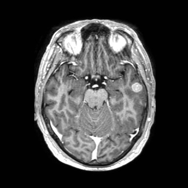 Brain metastases from lung cancer (Radiopaedia 83839-99028 Axial T1 C+ 22).jpg