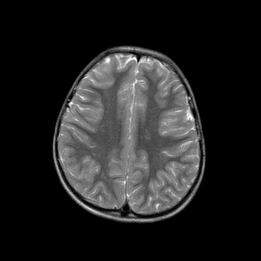 File:Brainstem ganglioglioma (Radiopaedia 10763-11224 Axial T2 6).jpg
