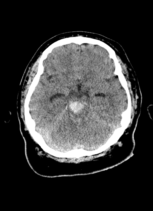 Brainstem hemorrhage (Radiopaedia 81294-94976 Axial non-contrast 40).jpg