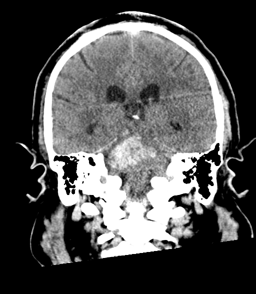 Brainstem hemorrhage (Radiopaedia 81294-94976 Coronal non-contrast 42).jpg